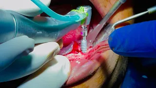 Implant Supported Over Denture For Mandible | Surgical Phase | Dr Brijesh Byrappa | Dental Experts