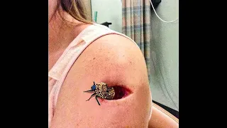 this GIANT BUG was in my arm...