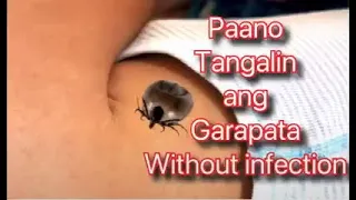 Paano Tanggalin ang Garapata sa Balat WITHOUT INFECTION | Garapata sa Bata | Garapata