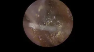 840 - Very Tricky Grommet & Ear Wax Removal