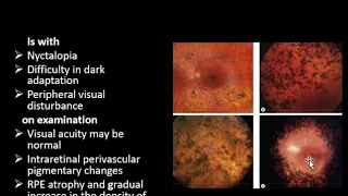 retinitis pigmentosa Lecture 8 By Dr Shoaib Class 4th Year