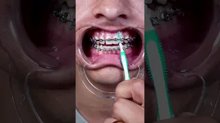 WHAT!? We're brushing our braces wrong!?