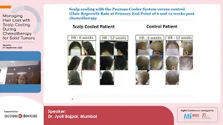 Part 2 - Myths and Facts about Scalp Cooling for chemotherapy-induced Alopecia - Dr. Jyoti Bajpai