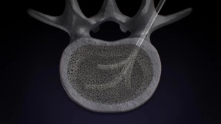 StabiliT® MX Vertebral Augmentation System