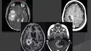 Brain Scans: Lord of the Ring Enhancing Lesions 101