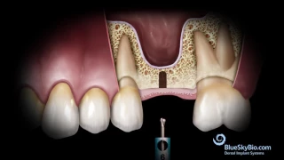 Basic Hammerless Sinus Lift Instrument Technique