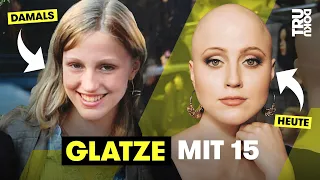 Wenn dir alle Haare ausfallen – Julies Leben mit Alopecia I TRU DOKU