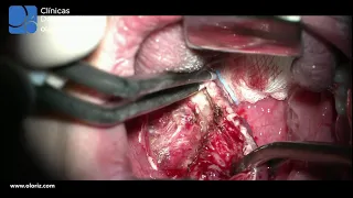 BIPOLAR TONSILLECTOMY (REAL TIME SURGERY)