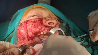 Maxillectomy by Dr . Mohamed Elshamaa