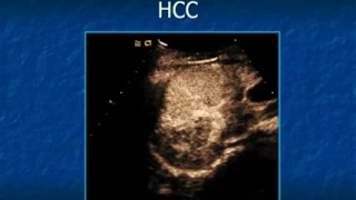 Hepatic Sonography A “Whirlwind Tour”