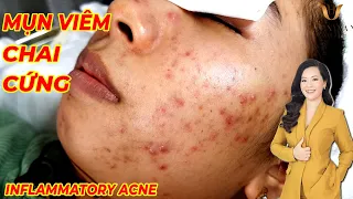 Điều trị mụn viêm chai cứng hiệu quả | Trị mụn tại TPHCM | Inflammatory Acne | Hiền Vân spa| 640