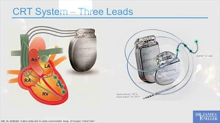 Cardiac Resynchronization Therapy (CRT): Making Non-Response a Non-Issue with MultiPoint Pacing