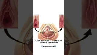 Лазерное интимное омоложение по акции