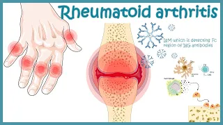 Rheumatoid Arthritis | autoimmune disorder | Pathophysiology, risk factors ,treatment.