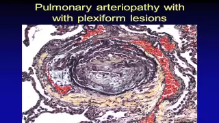 Pulmonary Hypertension Pathology