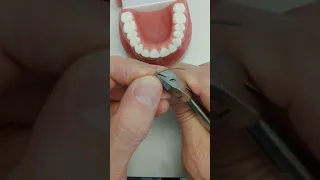 Upper fixed retainer technique