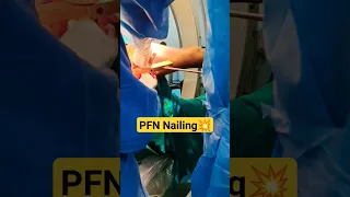 PFN Nail Femur 💥 Screw Insertion Femur