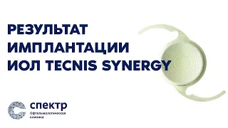 Результат операции по замене хрусталика на ИОЛ TECNIS Synergy