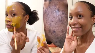 Say Bye bye to ACNE,PIMPLES(works 100%) using this turmeric honey mask