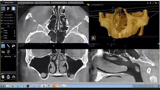 CS 3D Imaging Software Training: CBCT Anatomical Review of the Maxillary Region