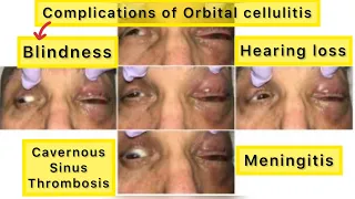 Orbital cellulitis complications