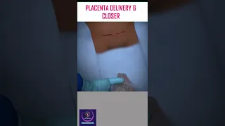 Placenta Delivery & Closure After C-Section