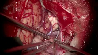 Right sided large fusiform partially thrombosed PICA aneurysm: Excision of aneurysm