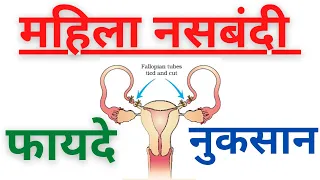 22. महिला नसबंदी ।। Tubal Ligation ।। कुछ अनकहे तथ्य