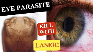 EYE PARASITES | HOW TO KILL A PARASITE IN THE EYE