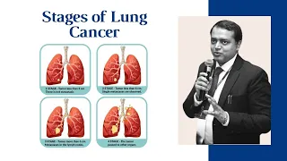 What are the Stages of Lung Cancer | Most Curable Stage of Lung Cancer | ft. Dr. Manish Singhal