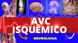 ACIDENTE VASCULAR CEREBRAL ISQUÊMICO (CAUSAS, SINTOMAS, DIAGNÓSTICO E TRATAMENTO) - AVC ISQUÊMICO