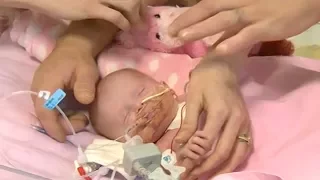 Baby born with heart outside body survives surgery