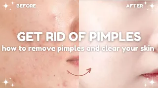 how to get rid of pimples and clear your skin 🧴🫧 acne treatments and do's and don'ts