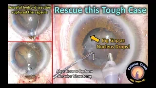Tough Cataract Surgery: Ruptured Capsule, Anterior Vitrectomy, Sulcus IOL, Great Outcome