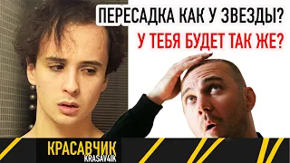 Пересадка как у звезды, Слава Марлоу сделал пересадку?  Красавчик