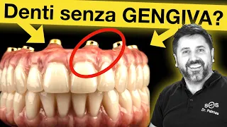 Arcata dentale su impianti con o senza gengiva? Tutto ciò che devi sapere.