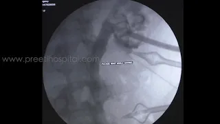 Dreadful complication of Post RIRS after 3 months (Pyonephrosis + Perinephric Abscess )