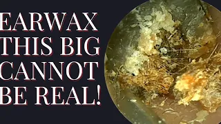 Earwax This Big Cannot Be Real !