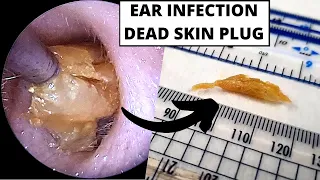 Dead Skin Plug Pulled From Ear (Caused By Otitis Externa)
