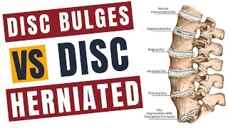 Disc Bulges vs Disc Herniated management and pain relief