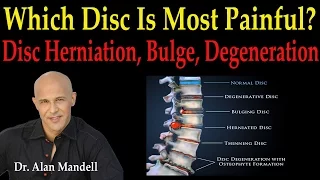 Which Disc Is Most Painful?  Disc Herniation, Disc Bulge, or Disc Degeneration?  -  Dr Mandell