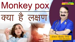 Monkey pox के क्या है लक्षण || MONKEY POX VIRUS FOR YOUR AWARENESS THE SYMPTOMS