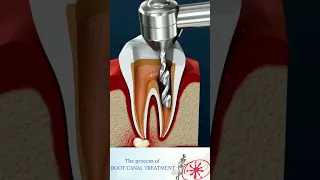 Вот как пломбируют зуб