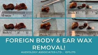 FOREIGN BODY & EAR WAX REMOVAL - EP175