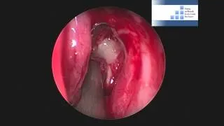 Endoscopic Endonasal Decompression of the Lamina Papyracea