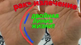 Рак, излечение. Тонула в детстве. Двойная линия жизни - это одни проблемы? хиромантия