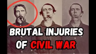 Civil War AMPUTATIONS: The War with the WORST Wounds