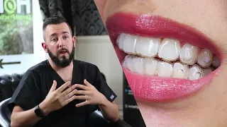 How Invisalign changes your face