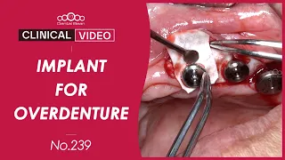 Upper implant placement for implant overdenture - [Dr. Kim Jaeyoon]