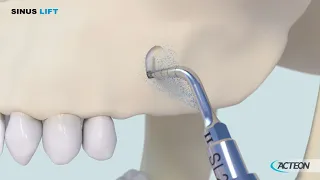 Sinus Lift 3D protocol